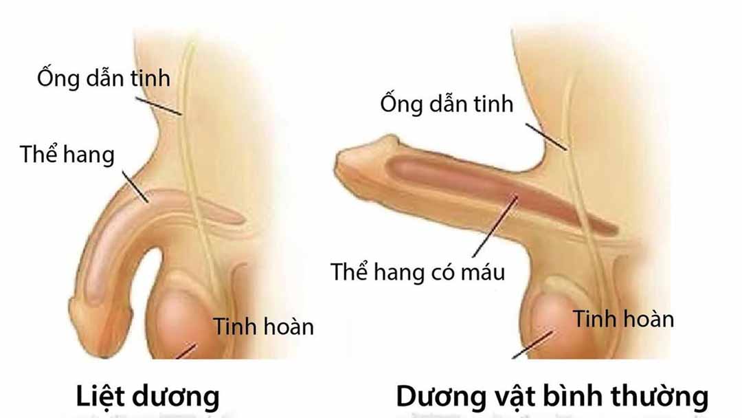 Rối loạn cương dương
